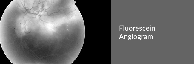 Fluorescein Angiogram