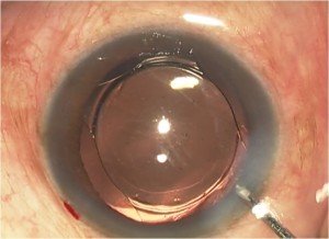 Micro Incision Lens