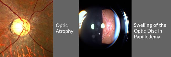 Optic_Atrophy