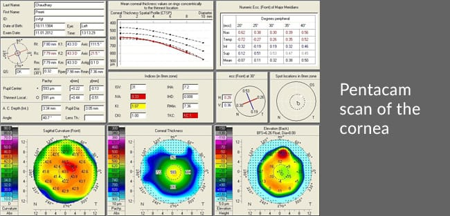 Pentacam scan of the cornea