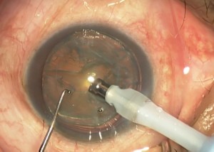 Phacoemulsifcation surgery being performed.