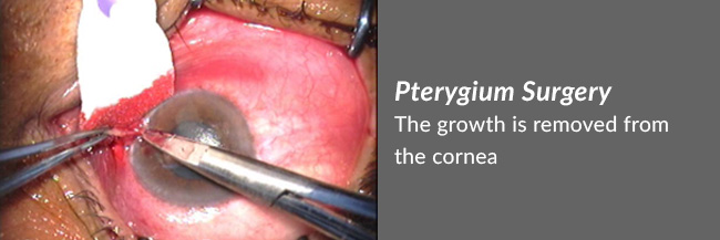 Pterygium surgery