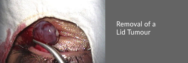 Removal of a lid tumour