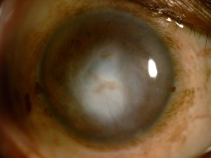 A dense white corneal scar that necessitates a cornea transplant