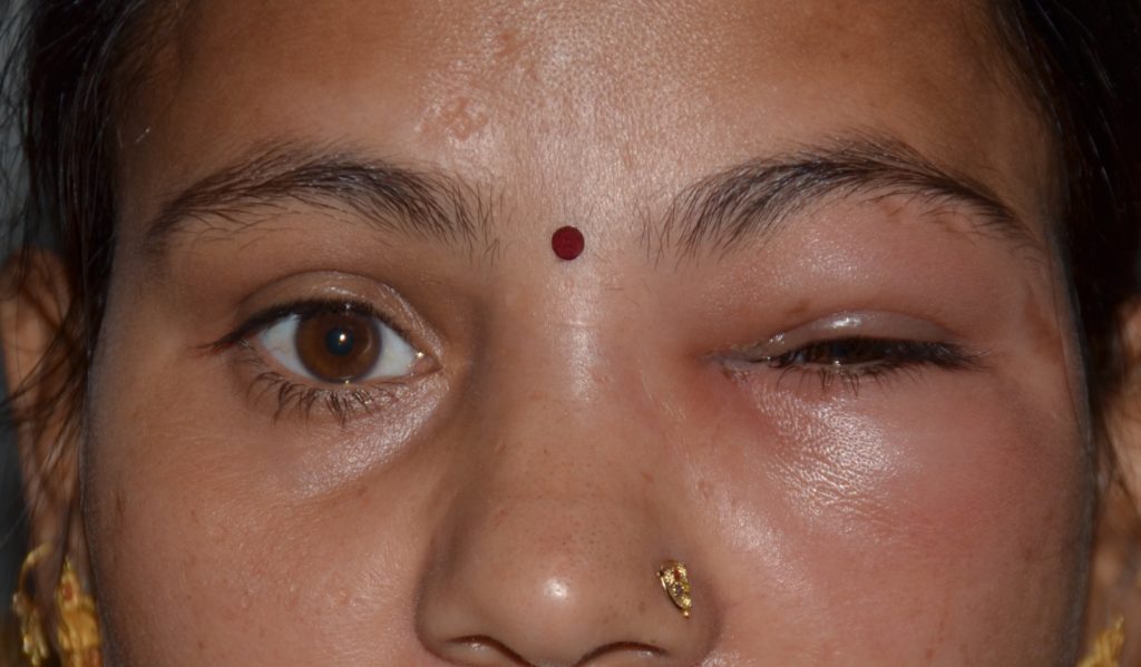 Dacryocystitis - Amritsar Eye Clinic